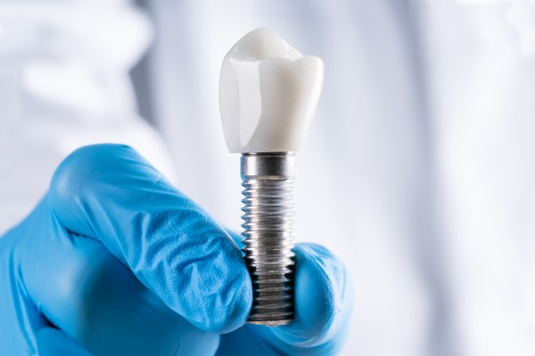 Myths About Dental Implants
